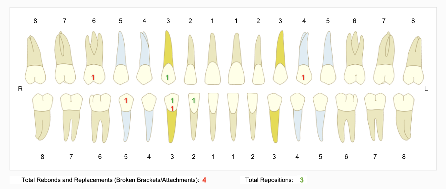 A screenshot of a tooth chart with red and green numbers over some teeth, indicating the number of broken brackets and replacements that the patient has had