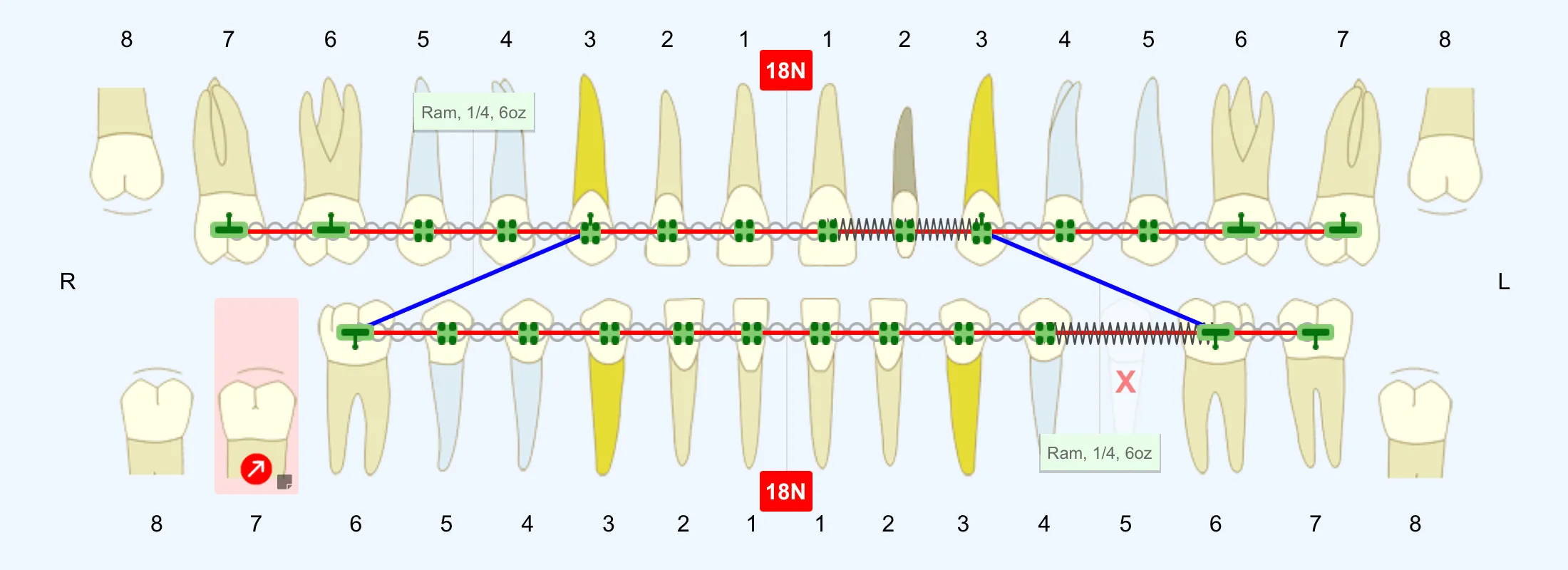 Tx Card Pro — braces treatment charting interface